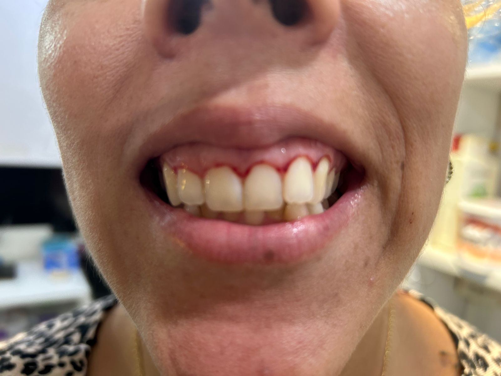 Paciente com gengivoplastia