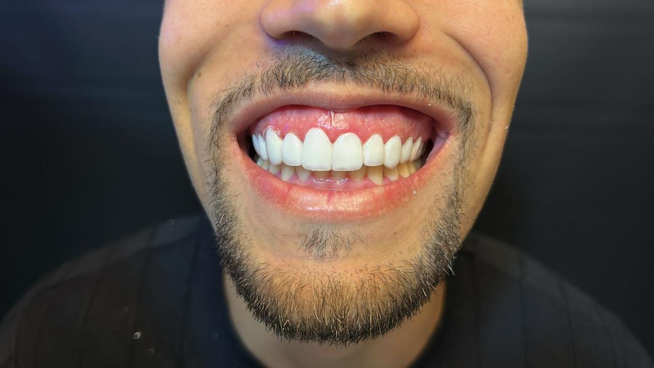 Paciente em procedimento estético dental
