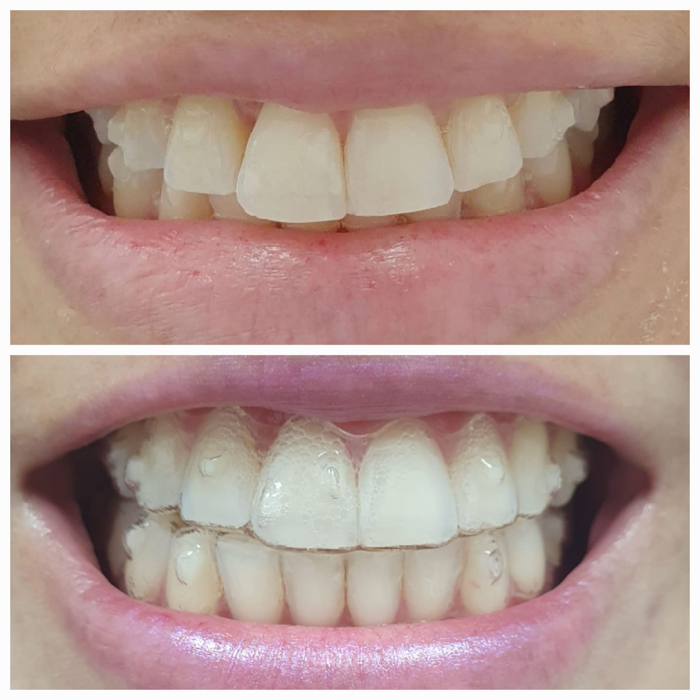 Paciente com Invisalign